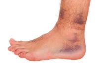 Painful Ankle Sprains