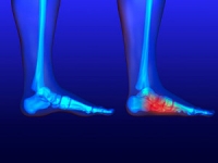 Do You Have Flat Feet?
